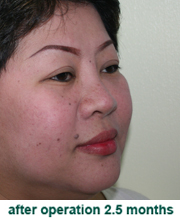 plastic_surgery_augmentation_rhinoplasty